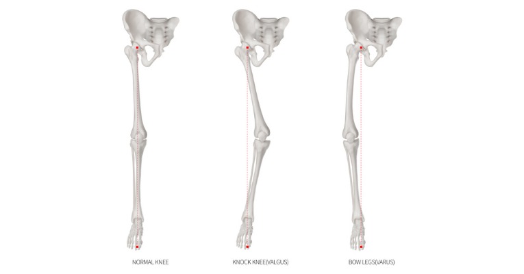 photo anatomique squelettique comparative de 3 morphologies différentes qui met en évidence le lien entre alignement du genou et apparition de l'arthrose de genou ou gonarthrose