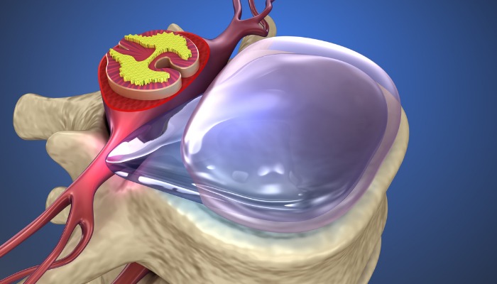 vue anatomie 3D de 3/4 avant d'une hernie discale cause de douleurs dorsales type cervicalgie, lombalgie, sciatique