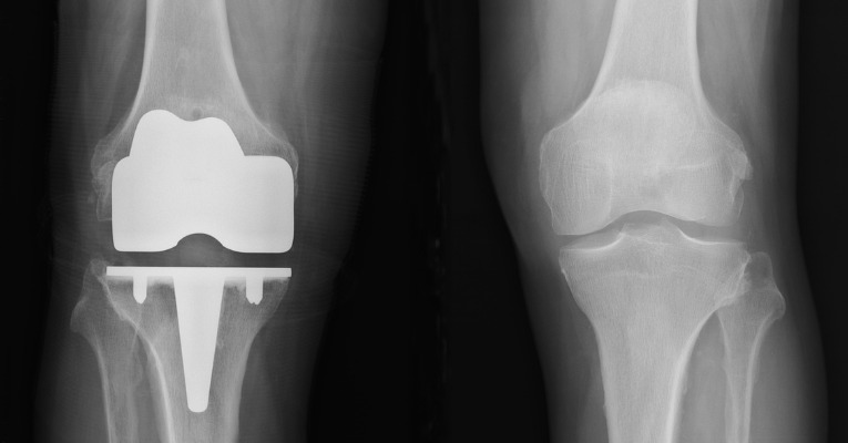 radiographie d'une prothèse de genou et d'un genou avec arthrose et gonarthrose non opéré qui met en avant l'intérêt de la chirurgie pour soulager les douleurs