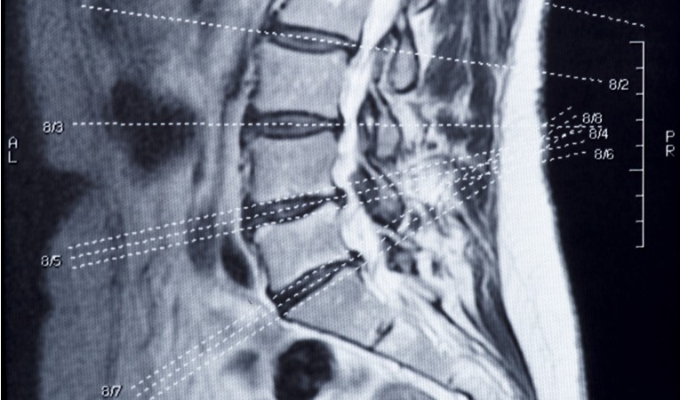 photo IRM lombaire du bas du dos avec hernie discale et lombalgie chronique