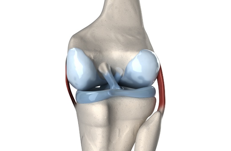 photo anatomique vue de derrière qui met en évidence la localisation des ligament du genou et la localisation de la rupture du ligament croisé du genou