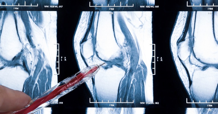 photo d'un irm de genou et présentation de la position exact de la rupture du ligament croisé du genou par un médecin docteur