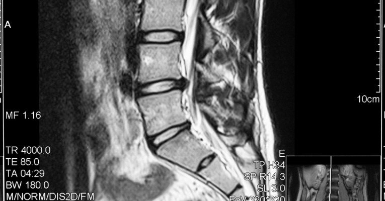 hernie discale visible sur une IRM