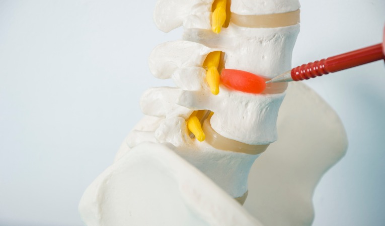 présentation anatomique colonne vertébrale de profil avec hernie discale expliquant une sciatique