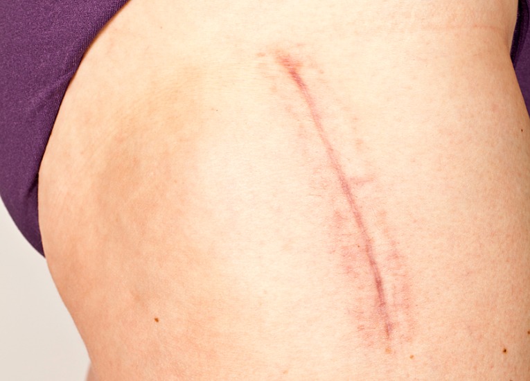 photo rapprochée de la cicatrice post opératoire d'une prothèse totale de hanche