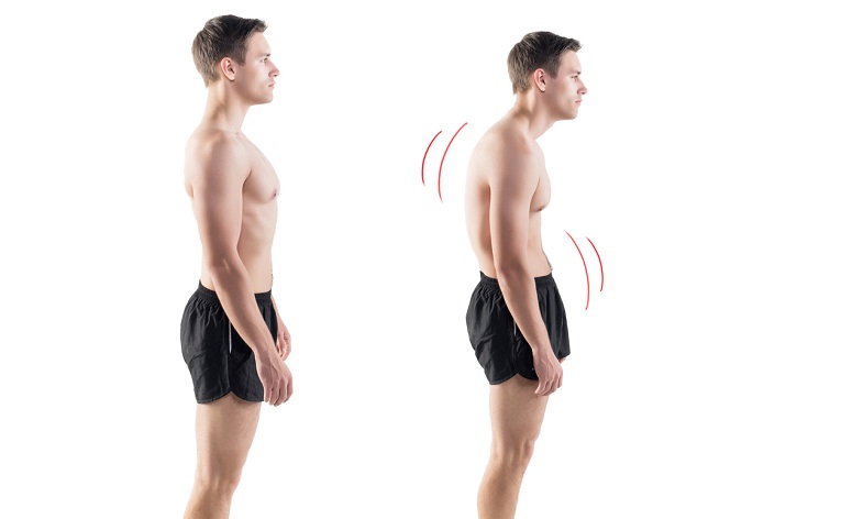 photo comparative bonne posture vs mauvaise posture chez un jeune homme en tenue de sport afin de mettre en évidence l'influence de la posture du dos sur les douleurs d'épaule et de tendinite