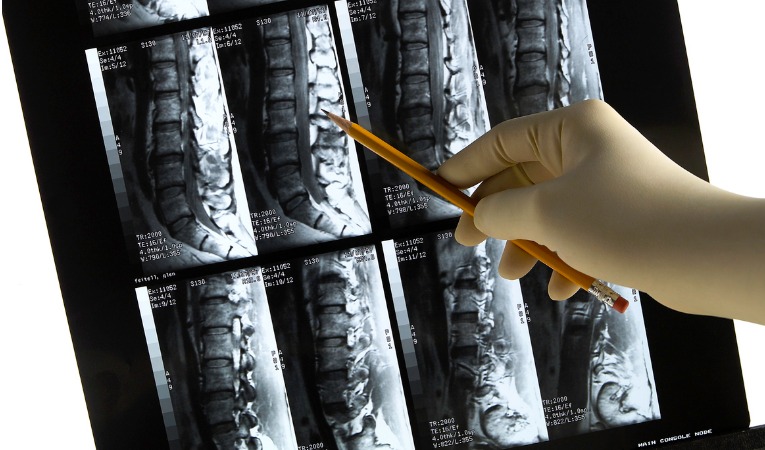 docteur donne les explications d'un IRM du dos pour douleurs lombaires type lombalgie chronique avec hernie discale