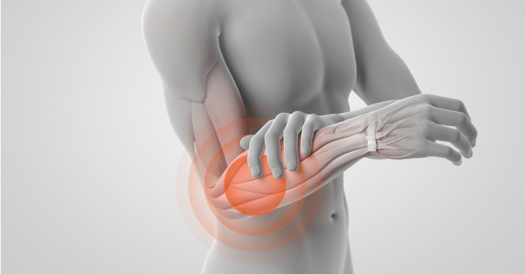 photo anatomique musculo-squelettique 3D d'un mannequin qui précise l'origine de la douleur d'une tendinite externe du coude et montre qu'elle peut se diffuser jusque dans le bras, l'avant bras ou le poignet en cas de tennis elbow