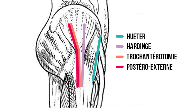 dessin anatomique de profil des voie d'abord pour chirurgie de prothèse de hanche