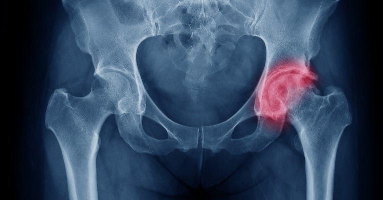 radiographie d'une hanche usée avec mise en évidence de l'arthrose en rouge pour démontrer la nécessité d'une chirurgie de la hanche avec pose d'une prothèse totale de hanche